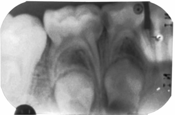 Fig. 2. Radiografía inicial.