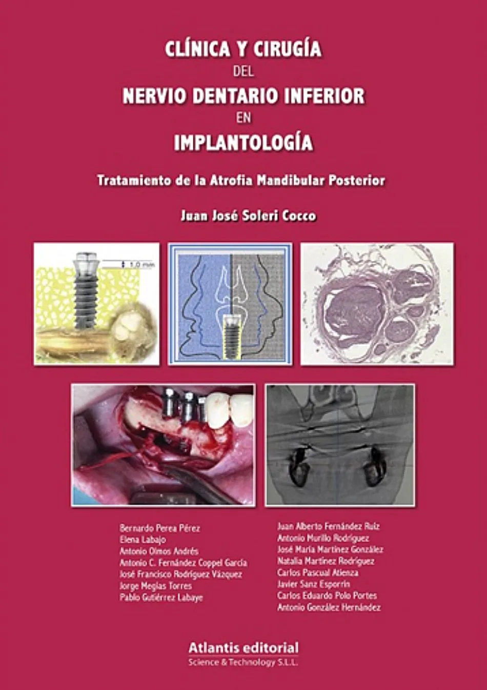 Clínica y Cirugía del Nervio Dentario Inferior en Implantología. Tratamiento de la Atrofia Mandibular Posterior